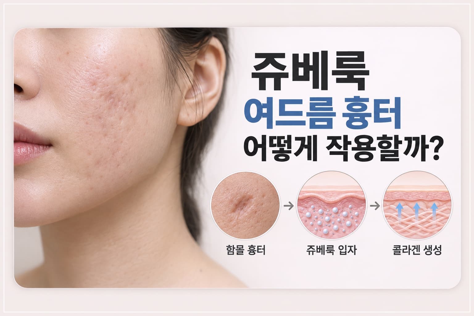 쥬베룩 여드름 흉터 어떻게 작용할까