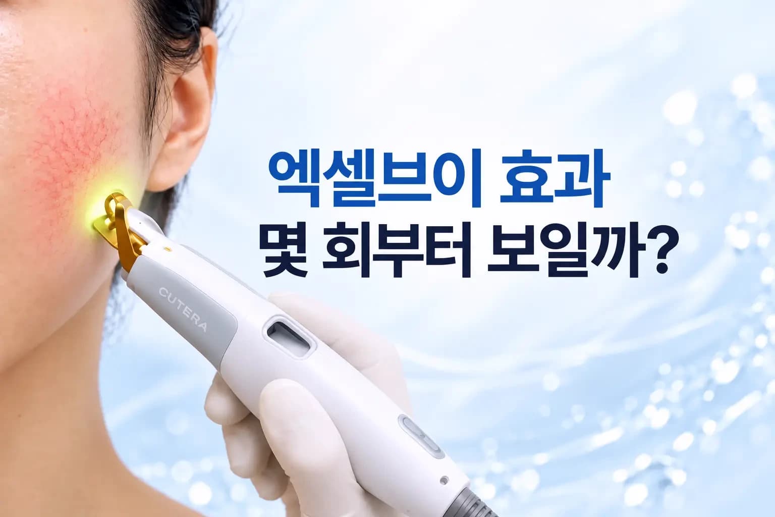 레이저 핸드피스 팁이 볼 피부의 미세혈관과 홍조 부위에 닿는 장면을 담은 엑셀브이 효과 썸네일