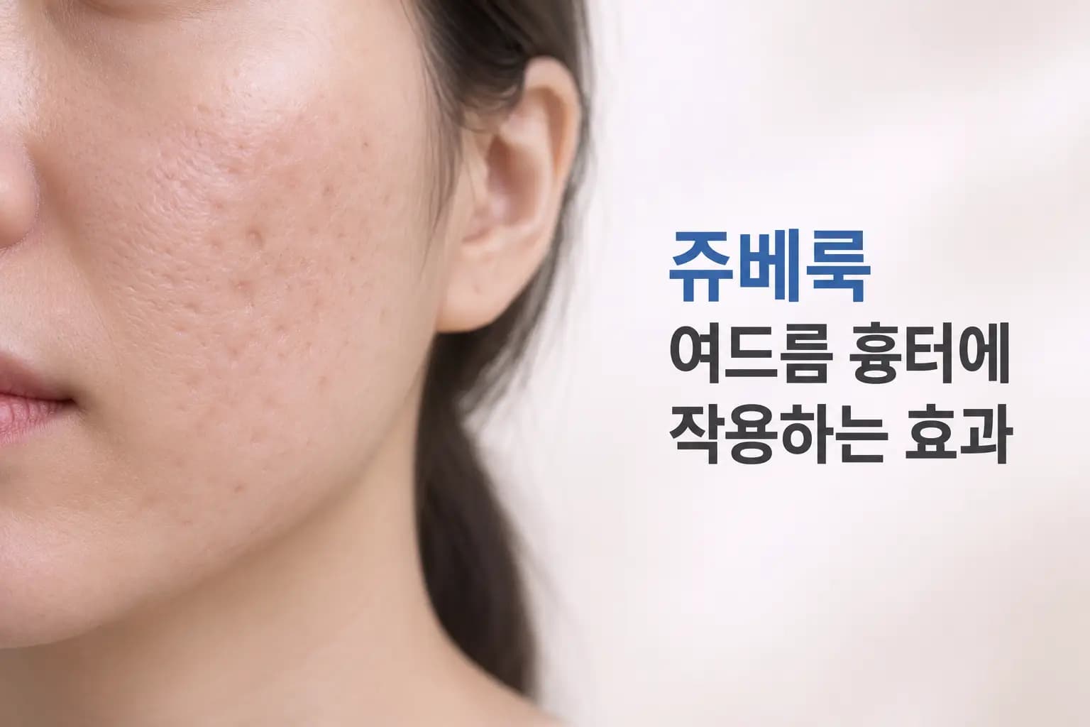 쥬베룩 여드름 흉터 어떻게 작용할까