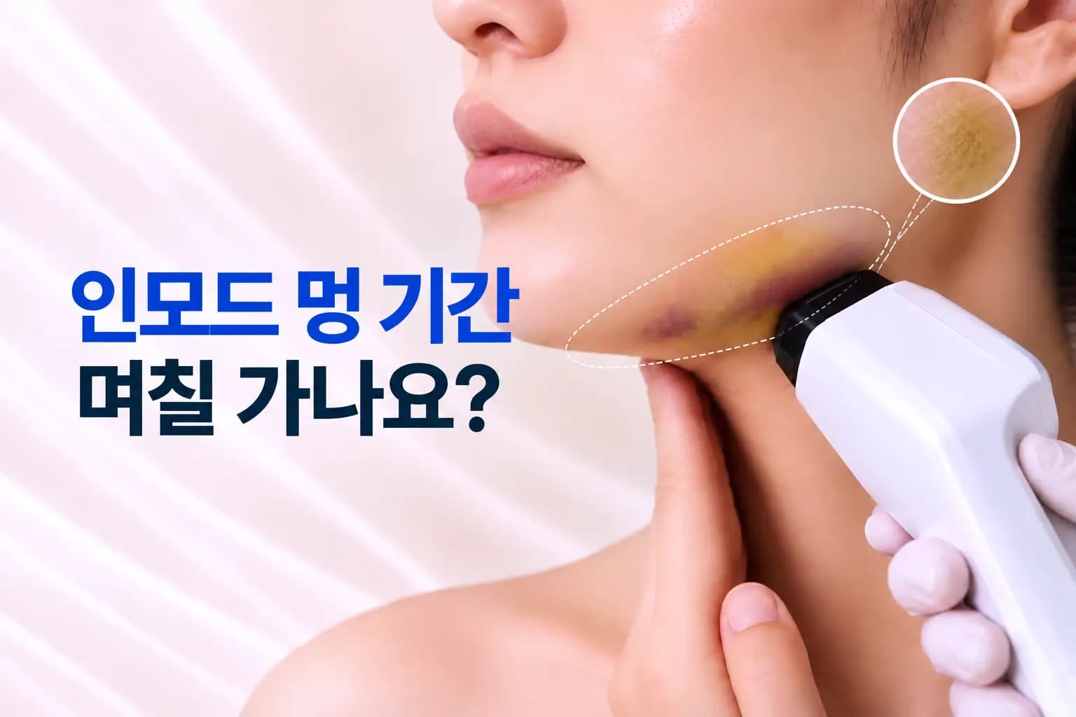 인모드 핸드피스 팁과 턱선 아래 옅어지는 멍을 확대 원형 인셋으로 담은 인모드 멍 기간 썸네일